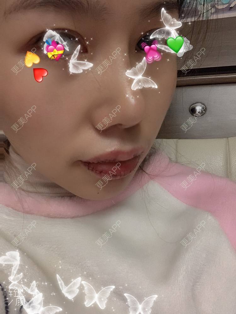 更美 - 浃浃！的厚唇改薄经验 | 厚唇改薄 | 上海