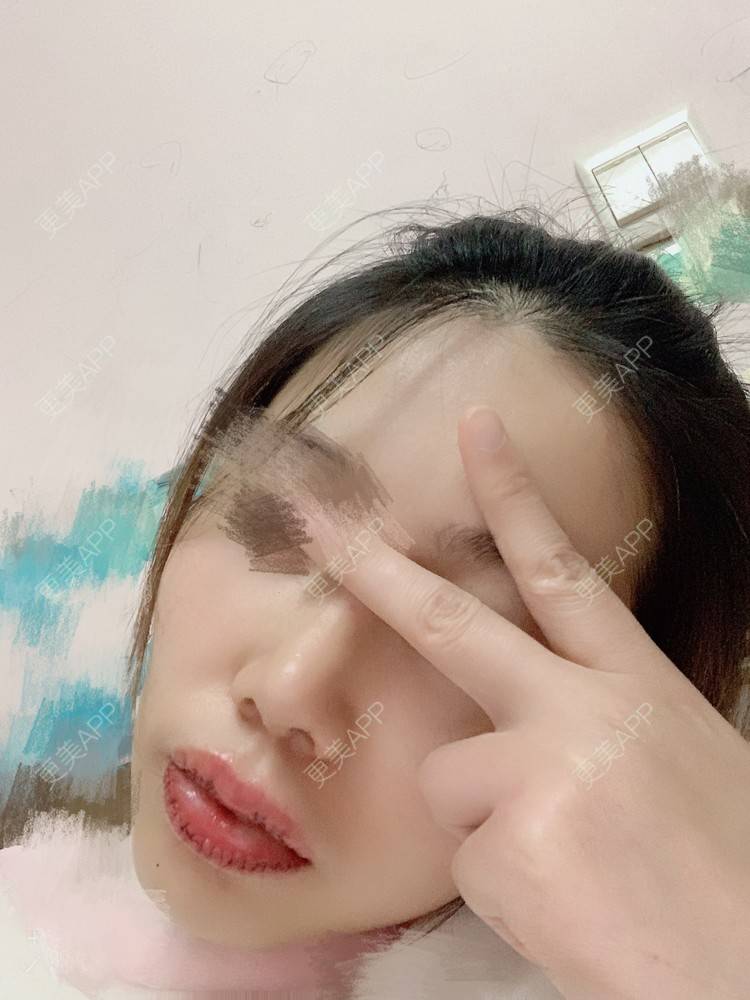 更美 - 浃浃！的厚唇改薄经验 | 厚唇改薄 | 上海