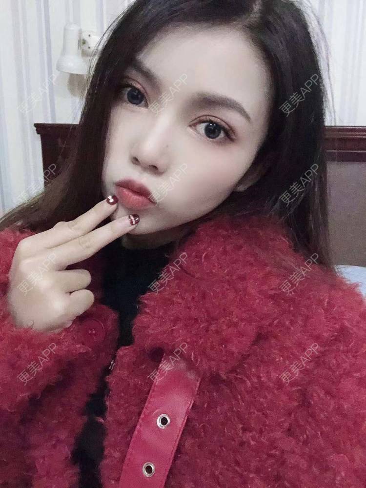 更美 - 更美用户T3PhxaY9Vo的玻尿酸下巴经验 | 广州 | 视频日记 | 玻尿酸下巴