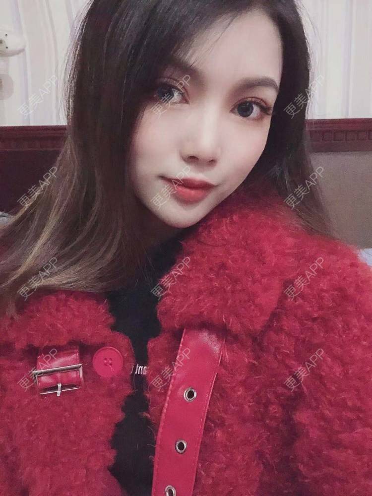 更美 - 更美用户T3PhxaY9Vo的玻尿酸下巴经验 | 广州 | 视频日记 | 玻尿酸下巴