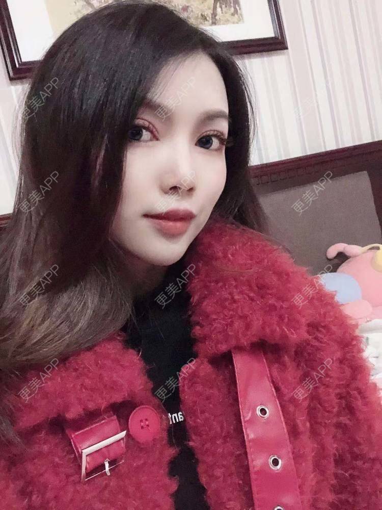 更美 - 更美用户T3PhxaY9Vo的玻尿酸下巴经验 | 广州 | 视频日记 | 玻尿酸下巴