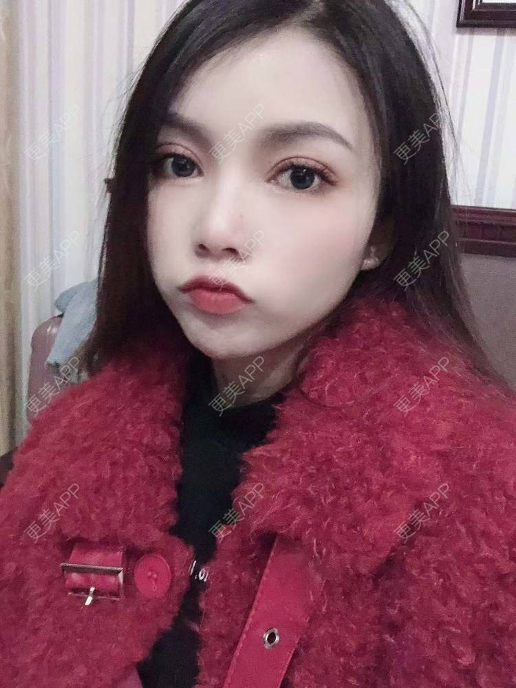 更美 - 更美用户T3PhxaY9Vo的玻尿酸下巴经验 | 广州 | 视频日记 | 玻尿酸下巴