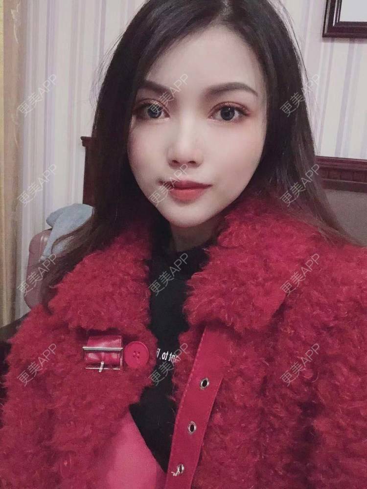 更美 - 更美用户T3PhxaY9Vo的玻尿酸下巴经验 | 广州 | 视频日记 | 玻尿酸下巴