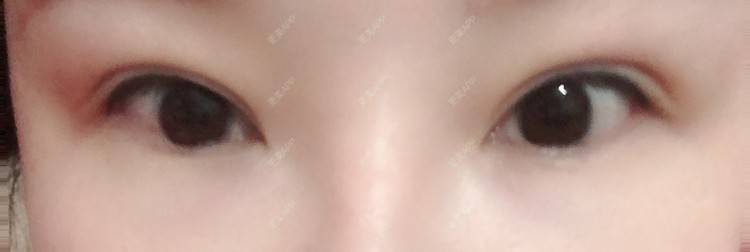 更美 - Ariesio的双眼皮修复经验 | 双眼皮修复 | 提眉修复 | 澳门特别行政区