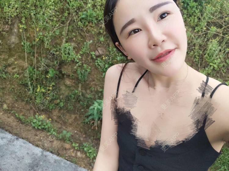 更美 - Ariesio的双眼皮修复经验 | 双眼皮修复 | 提眉修复 | 澳门特别行政区
