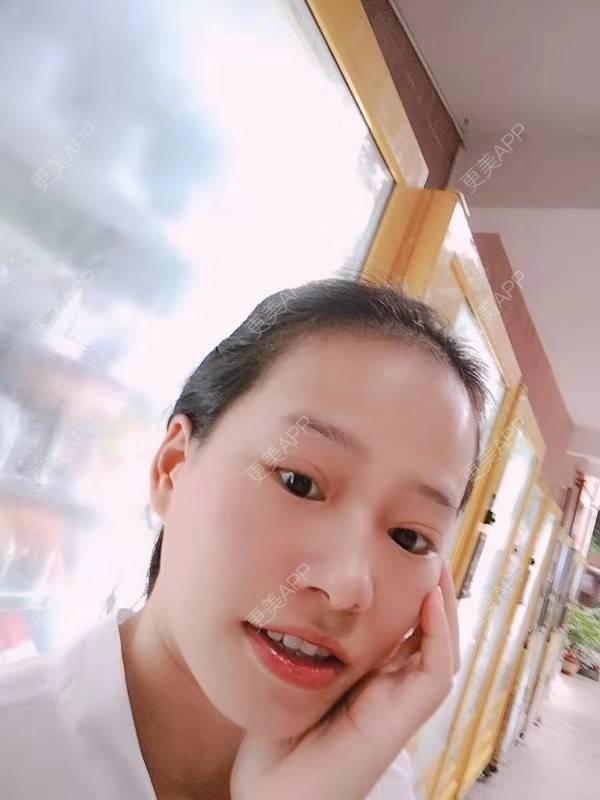 更美 - 更美用户reuLxRCjhq的全切双眼皮经验 | 全切双眼皮 | 开内眼角 | 开外眼角 | 重庆