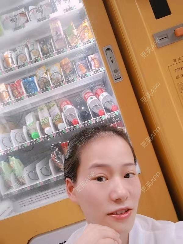 更美 - 更美用户reuLxRCjhq的全切双眼皮经验 | 全切双眼皮 | 开内眼角 | 开外眼角 | 重庆