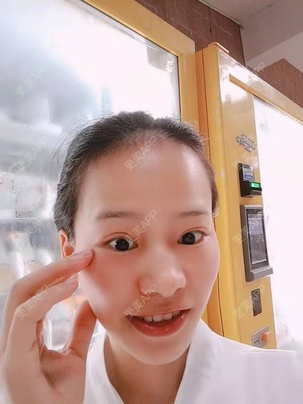 更美 - 更美用户reuLxRCjhq的全切双眼皮经验 | 全切双眼皮 | 开内眼角 | 开外眼角 | 重庆