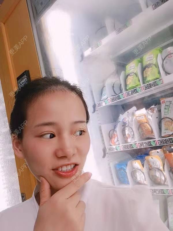更美 - 更美用户reuLxRCjhq的全切双眼皮经验 | 全切双眼皮 | 开内眼角 | 开外眼角 | 重庆