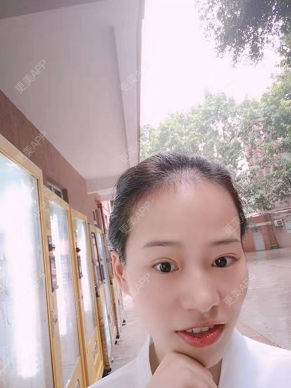 更美 - 更美用户reuLxRCjhq的全切双眼皮经验 | 全切双眼皮 | 开内眼角 | 开外眼角 | 重庆