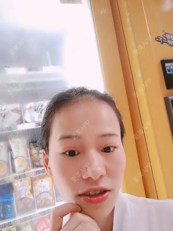 更美 - 更美用户reuLxRCjhq的全切双眼皮经验 | 全切双眼皮 | 开内眼角 | 开外眼角 | 重庆