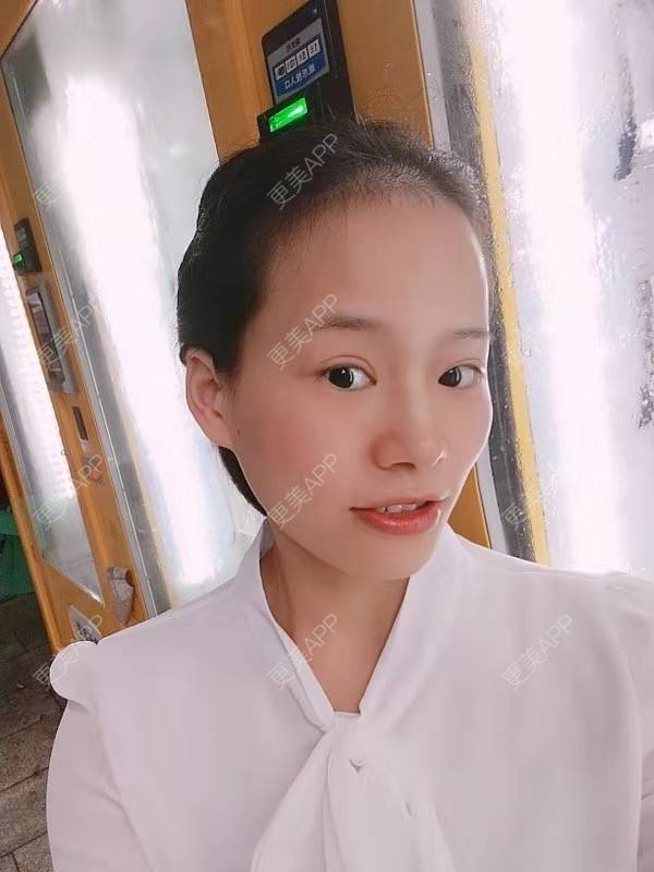 更美 - 更美用户reuLxRCjhq的全切双眼皮经验 | 全切双眼皮 | 开内眼角 | 开外眼角 | 重庆