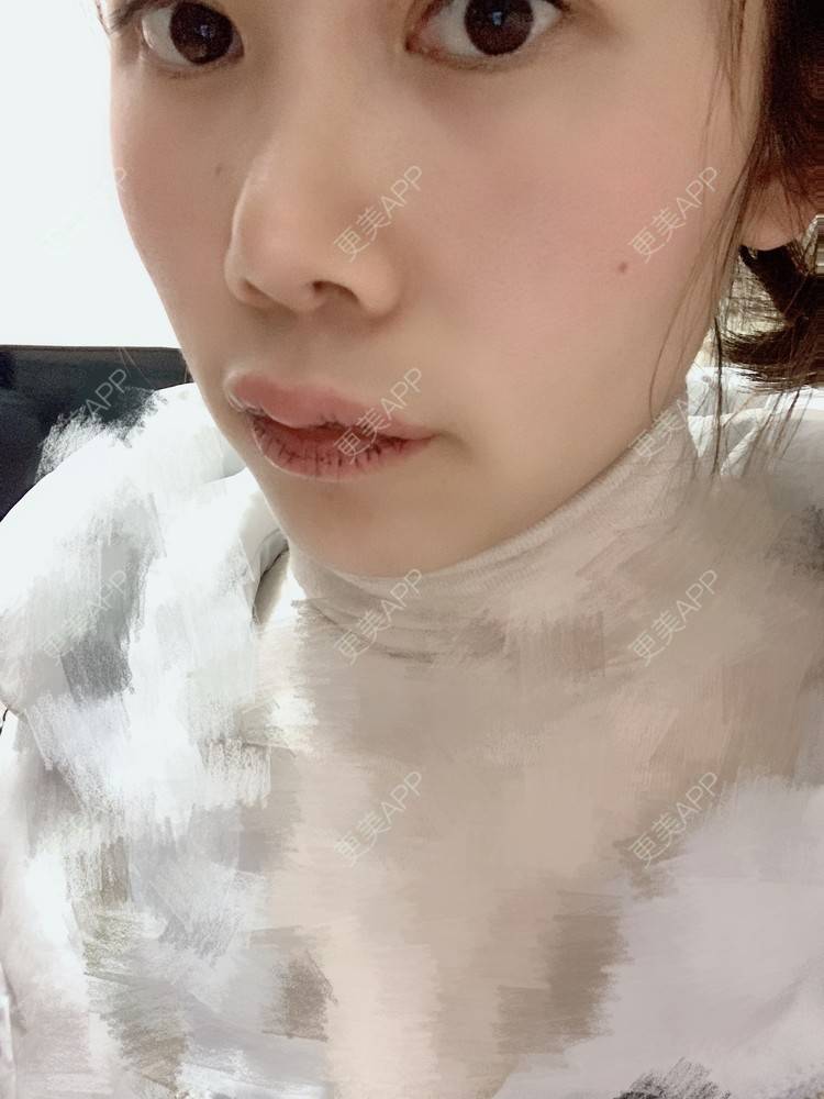 更美 - 浃浃！的厚唇改薄经验 | 厚唇改薄 | 上海