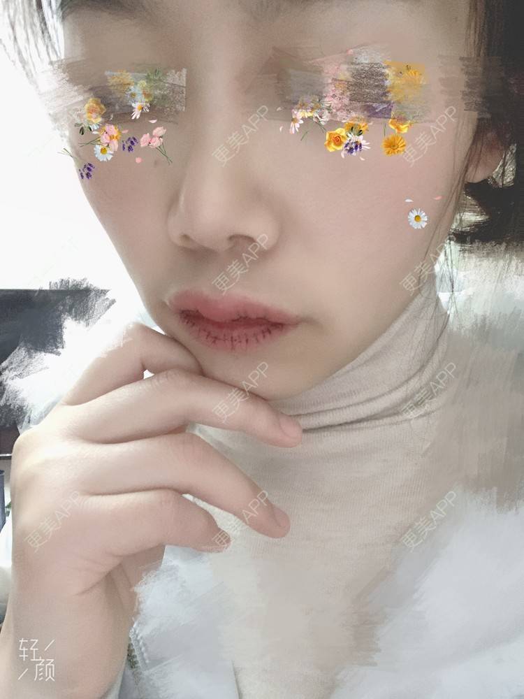 更美 - 浃浃！的厚唇改薄经验 | 厚唇改薄 | 上海