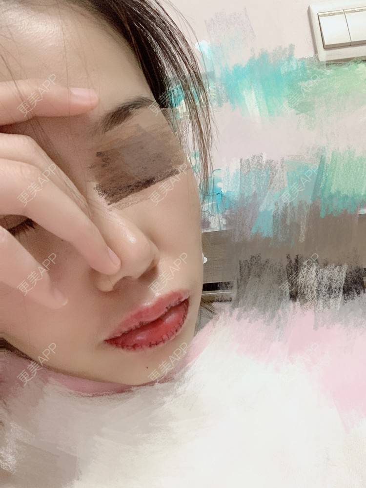 更美 - 浃浃！的厚唇改薄经验 | 厚唇改薄 | 上海