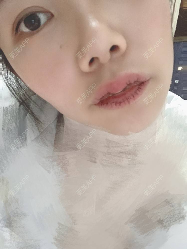 更美 - 浃浃！的厚唇改薄经验 | 厚唇改薄 | 上海