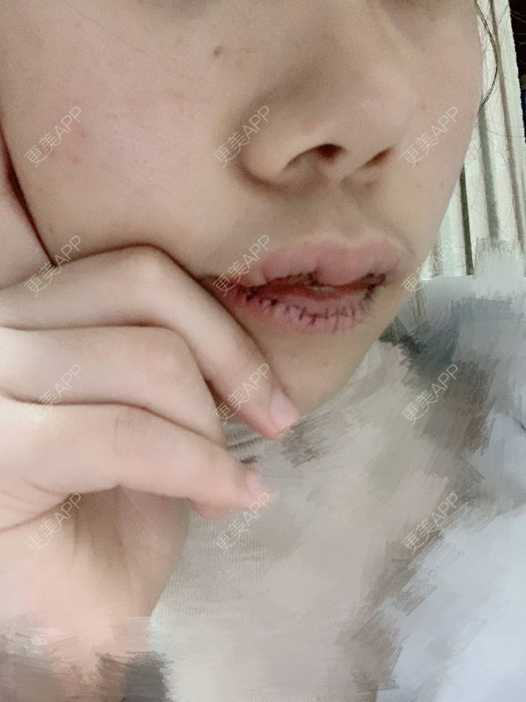 更美 - 浃浃！的厚唇改薄经验 | 厚唇改薄 | 上海