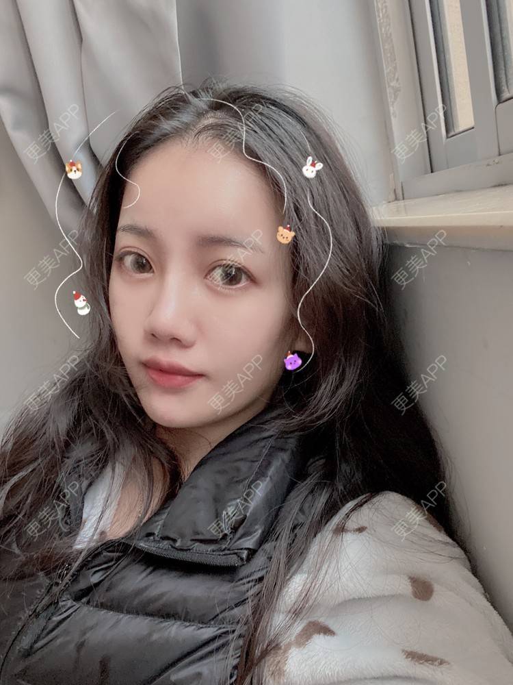 更美 - Dd酱哦的隆鼻经验 | 耳软骨隆鼻 | 硅胶隆鼻 | 隆鼻 | 鼻部多项 | 自体软骨垫鼻尖 | 温州