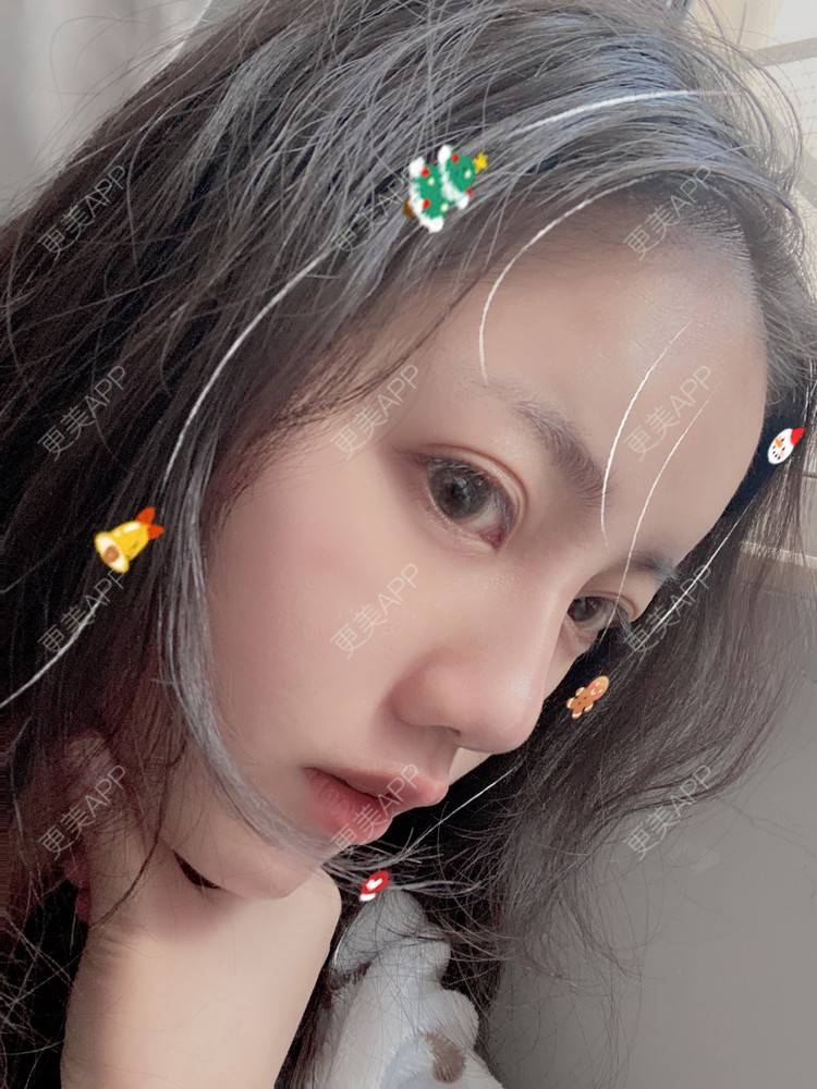 更美 - Dd酱哦的隆鼻经验 | 耳软骨隆鼻 | 硅胶隆鼻 | 隆鼻 | 鼻部多项 | 自体软骨垫鼻尖 | 温州