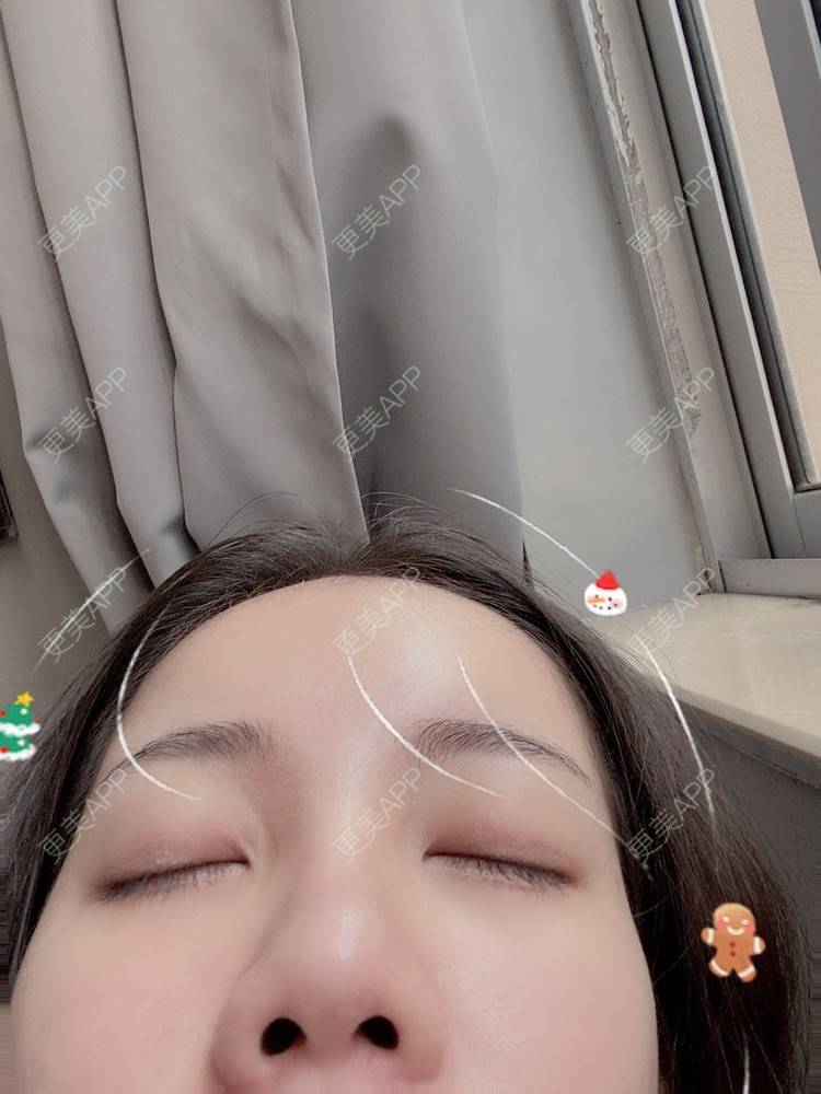 更美 - Dd酱哦的隆鼻经验 | 耳软骨隆鼻 | 硅胶隆鼻 | 隆鼻 | 鼻部多项 | 自体软骨垫鼻尖 | 温州
