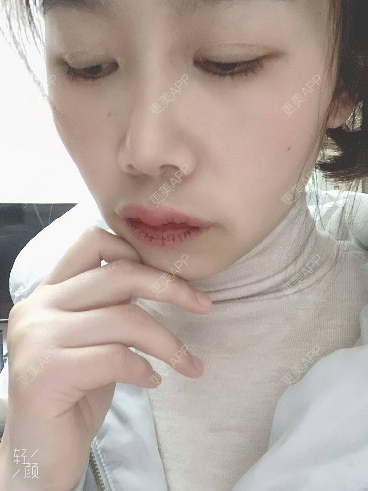 更美 - 浃浃！的厚唇改薄经验 | 厚唇改薄 | 上海