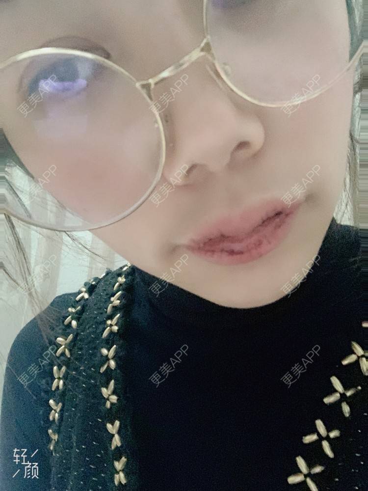 更美 - 浃浃！的厚唇改薄经验 | 厚唇改薄 | 上海