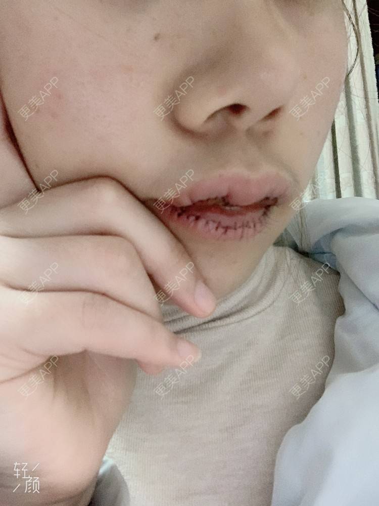 更美 - 浃浃！的厚唇改薄经验 | 厚唇改薄 | 上海