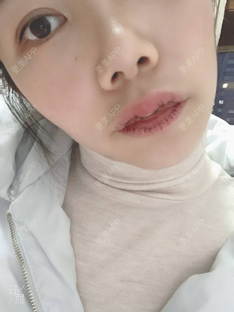 更美 - 浃浃！的厚唇改薄经验 | 厚唇改薄 | 上海