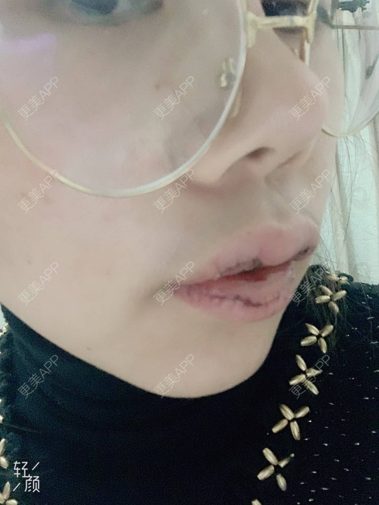 更美 - 浃浃！的厚唇改薄经验 | 厚唇改薄 | 上海