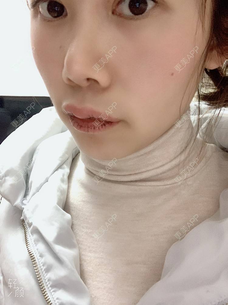 更美 - 浃浃！的厚唇改薄经验 | 厚唇改薄 | 上海