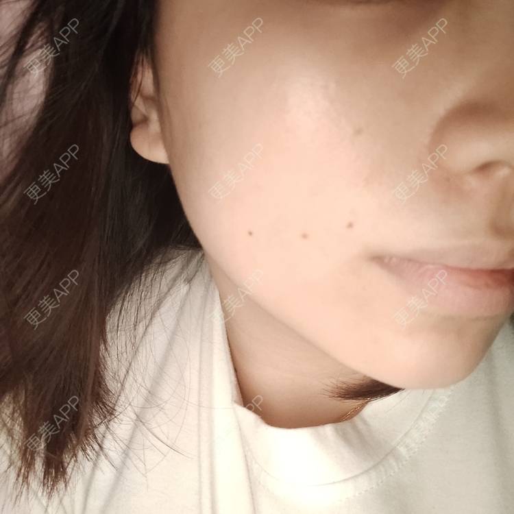 更美 - 更美用户DhJAzcizC5的美白嫩肤经验 | 水光项目 | 美白嫩肤 | 广州 | 激光脱腋毛 | 大腿脱毛