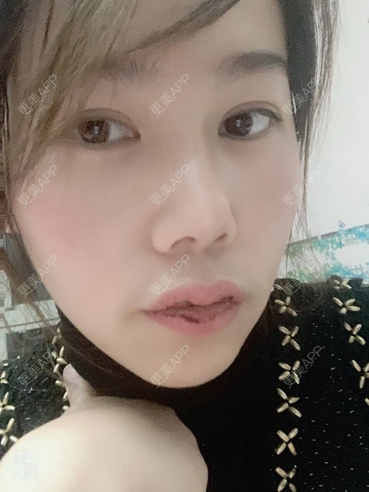 更美 - 浃浃！的厚唇改薄经验 | 厚唇改薄 | 上海