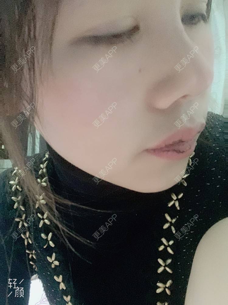 更美 - 浃浃！的厚唇改薄经验 | 厚唇改薄 | 上海