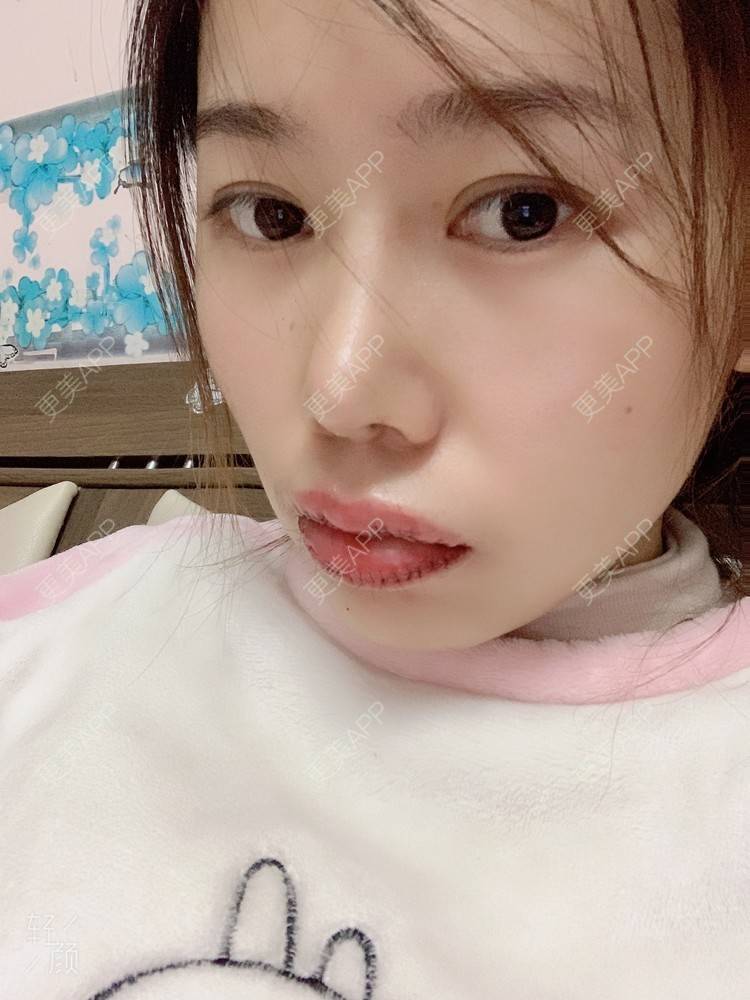 更美 - 浃浃！的厚唇改薄经验 | 厚唇改薄 | 上海