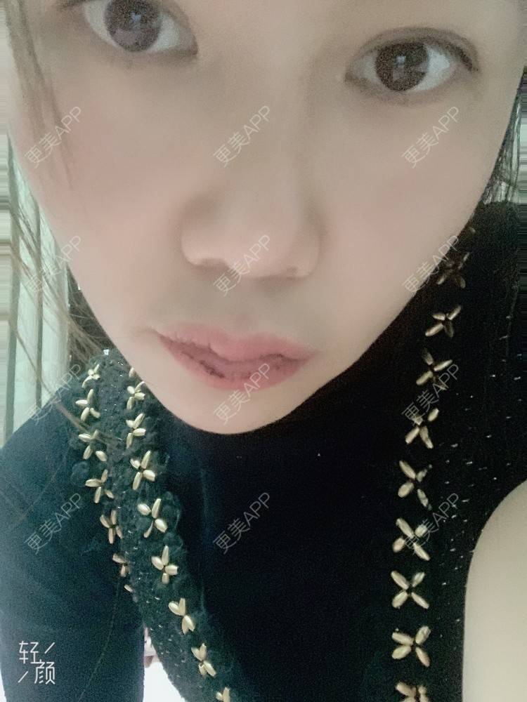 更美 - 浃浃！的厚唇改薄经验 | 厚唇改薄 | 上海