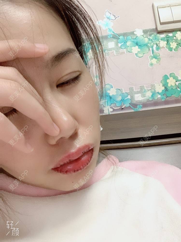 更美 - 浃浃！的厚唇改薄经验 | 厚唇改薄 | 上海