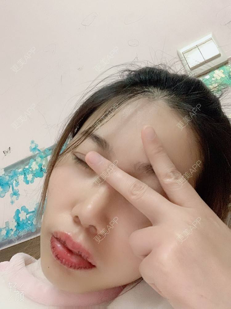 更美 - 浃浃！的厚唇改薄经验 | 厚唇改薄 | 上海