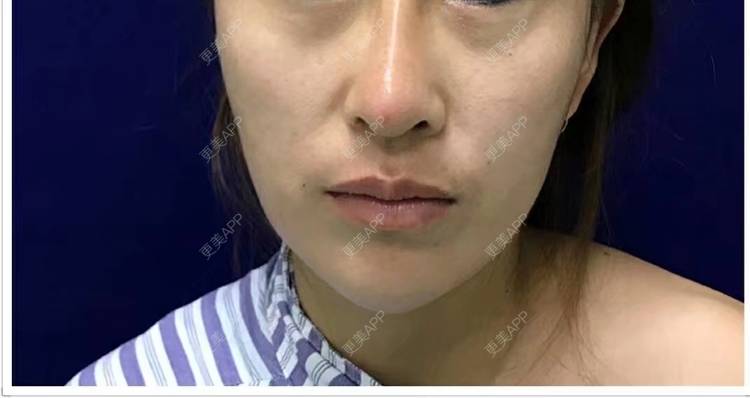 更美 - 本人的失败经历的硅胶隆鼻经验 | 上海 | 硅胶隆鼻