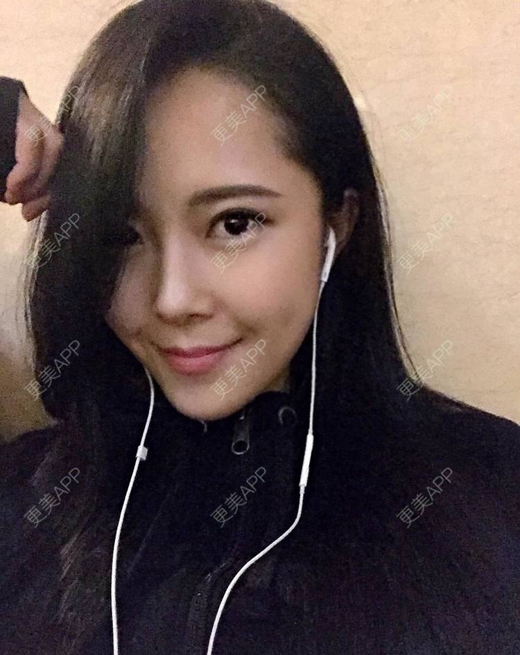 更美 - 青柠檬灬的吸脂瘦脸经验 | 吸脂瘦脸 | 重庆