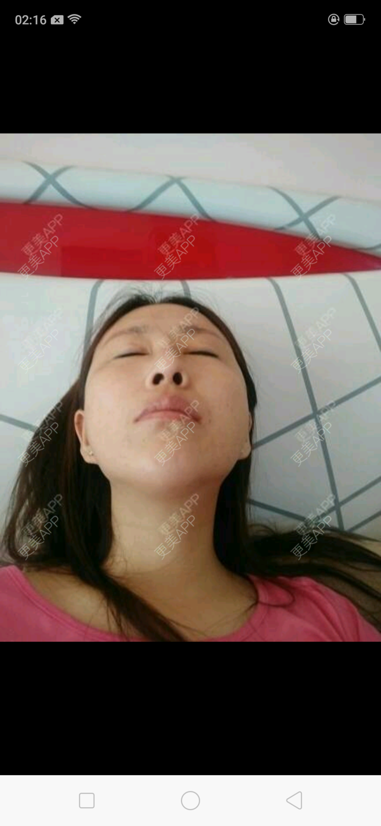 更美 - 本人的失败经历的硅胶隆鼻经验 | 硅胶隆鼻 | 上海