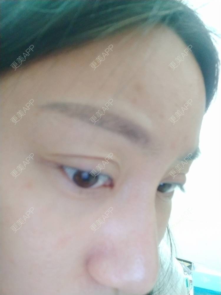 更美 - 逗逗是剩女的双眼皮经验 | 全切双眼皮 | 广州 | 埋线隆鼻 | 视频日记