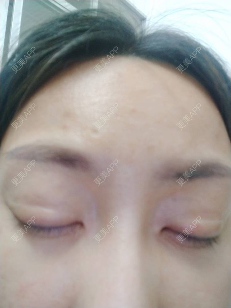 更美 - 逗逗是剩女的双眼皮经验 | 全切双眼皮 | 广州 | 埋线隆鼻 | 视频日记