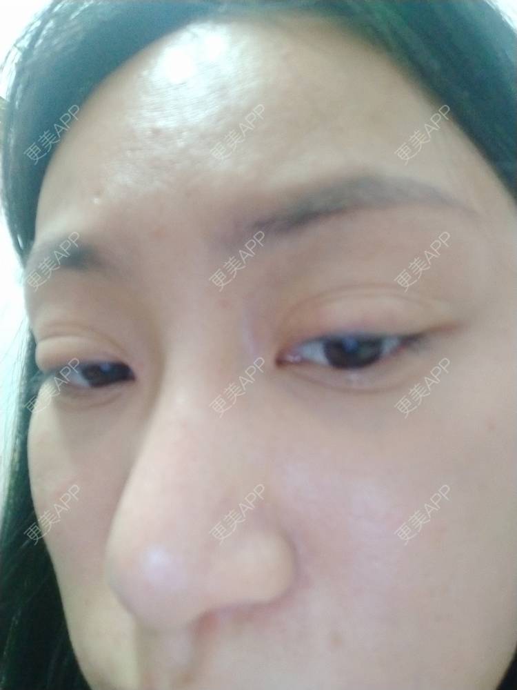 更美 - 逗逗是剩女的双眼皮经验 | 全切双眼皮 | 广州 | 埋线隆鼻 | 视频日记