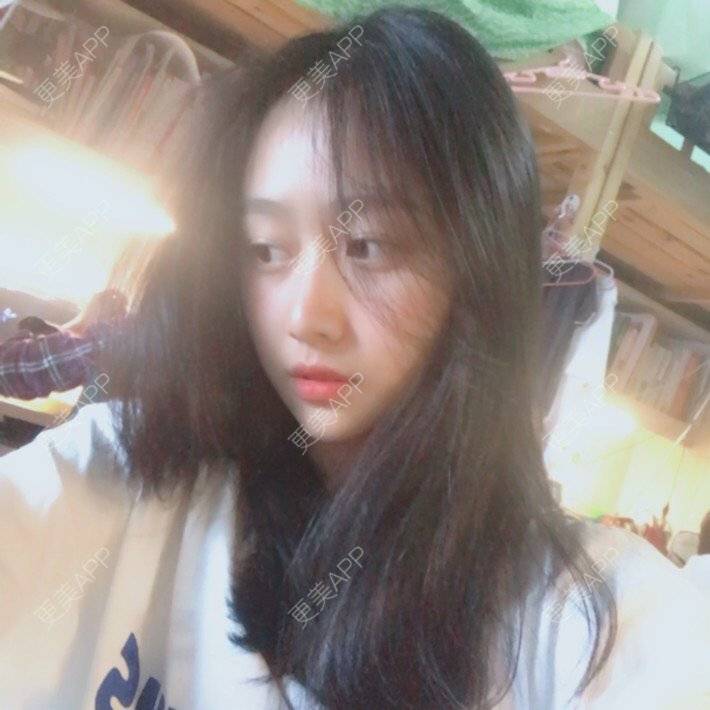 更美 - 更美用户sSaQkDrYUH的朝天鼻矫正经验 | 朝天鼻矫正 | 鼻翼缩小 | 假体垫鼻基底 | 人工骨隆鼻 | 真皮隆鼻 | 福州