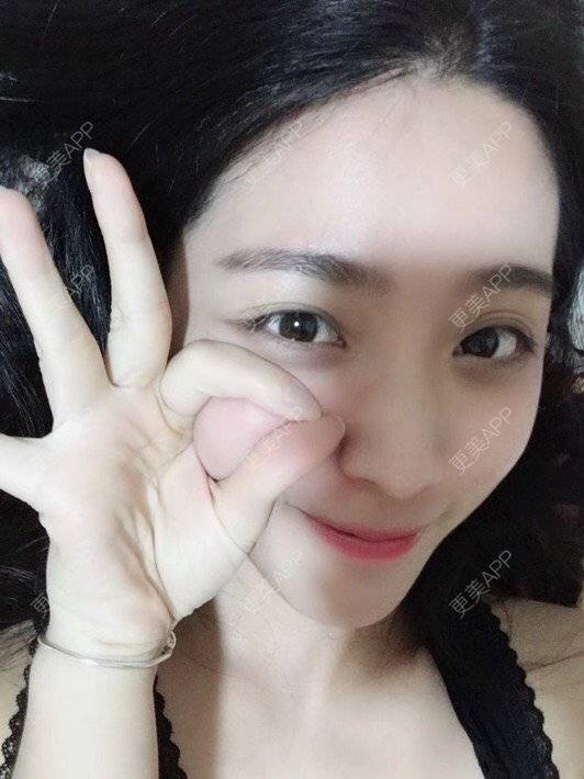 更美 - 更美用户brQjLleoin的鼻部多项经验 | 硅胶隆鼻 | 长鼻矫正 | 鼻翼缩小 | 假体垫鼻基底 | 鼻部多项 | 福州