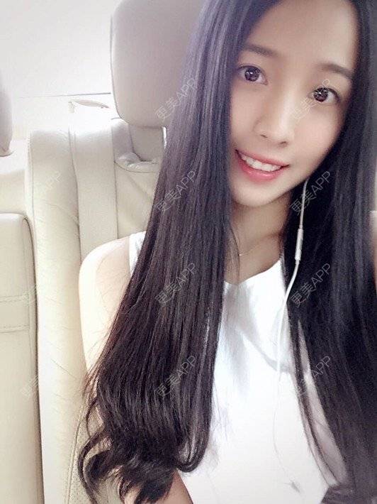 更美 - 更美用户brQjLleoin的鼻部多项经验 | 硅胶隆鼻 | 长鼻矫正 | 鼻翼缩小 | 假体垫鼻基底 | 鼻部多项 | 福州