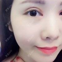 更美 - 郑州缔莱美医疗美容医院的全切双眼皮经验 | 全切双眼皮 | 眼部多项 | 郑州