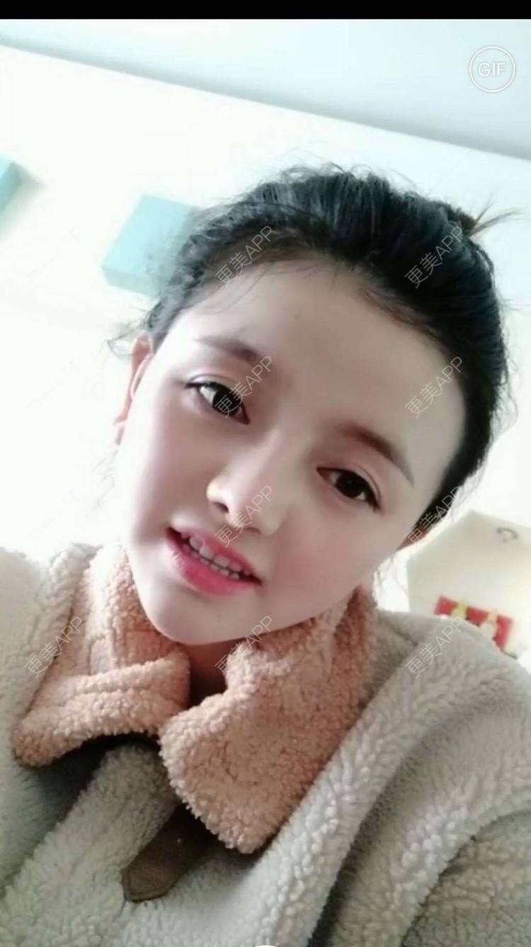 更美 - 二水酱的鼻部多项经验 | 鼻小柱延长 | 硅胶隆鼻 | 鼻孔矫正 | 自体软骨垫鼻尖 | 鼻部多项