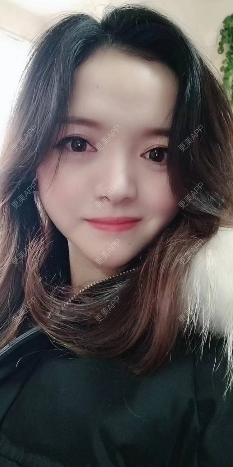 更美 - 二水酱的鼻部多项经验 | 鼻小柱延长 | 硅胶隆鼻 | 鼻孔矫正 | 自体软骨垫鼻尖 | 鼻部多项