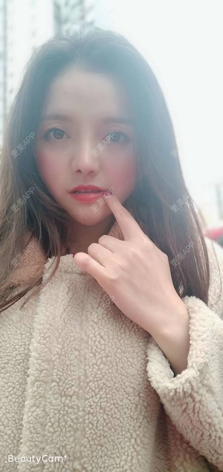 更美 - 二水酱的鼻部多项经验 | 鼻小柱延长 | 硅胶隆鼻 | 鼻孔矫正 | 自体软骨垫鼻尖 | 鼻部多项